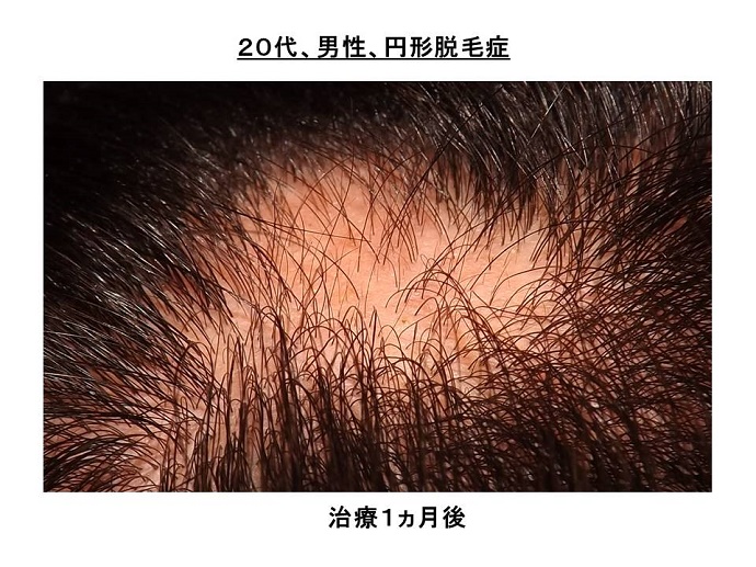 円形脱毛症　病院""